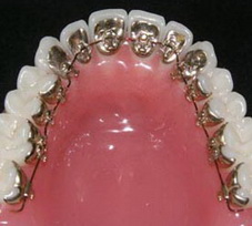 Внутренние (лингальные) брекеты установка лингвальных брекетов